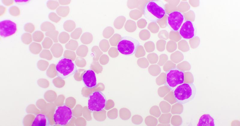 Blood picture of chronic lymphocytic leukemia or CLL, analyze by microscope, original magnification 1000x