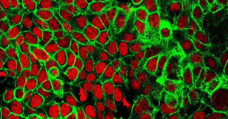 Human colon cancer cells with the cell nuclei stained red and the protein E-cadherin stained green.