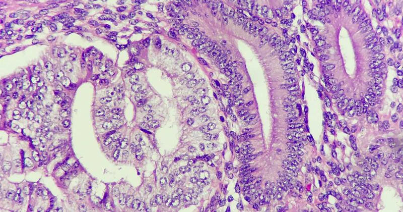 Photo of endometrial cancer on the left and normal endometrial gland on the right, magnification 400x