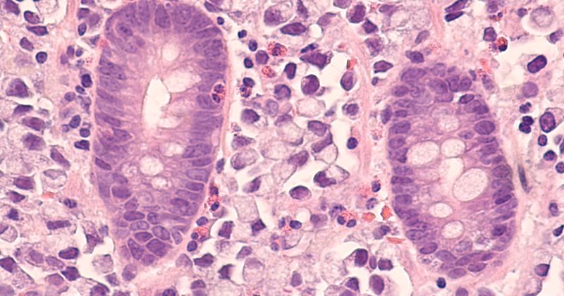 Microscopic image of stomach cancer (gastric adenocarcinoma) metastatic to colon.