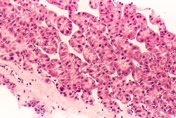 Photomicrograph of hepatocellular carcinoma (hepatoma), a malignant tumor often associated with chronic hepatitis