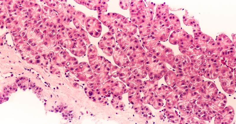 Photomicrograph of hepatocellular carcinoma (hepatoma), a malignant tumor often associated with chronic hepatitis