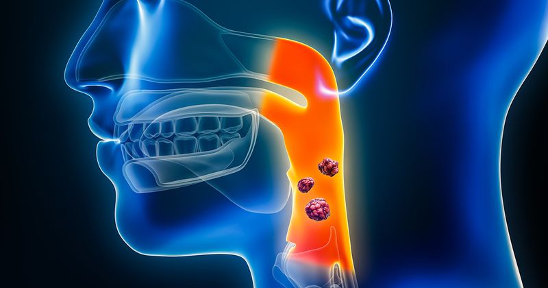 Pharyngeal or throat cancer with organs and tumors or cancerous cells 3D rendering illustration