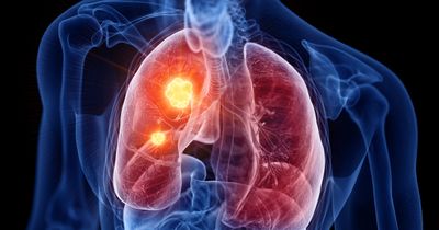 Patritumab deruxtecan extends PFS vs. chemotherapy in advanced non-small cell lung cancer