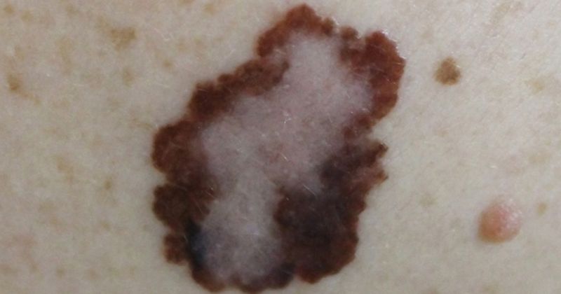 photo of melanoma/skin cancer