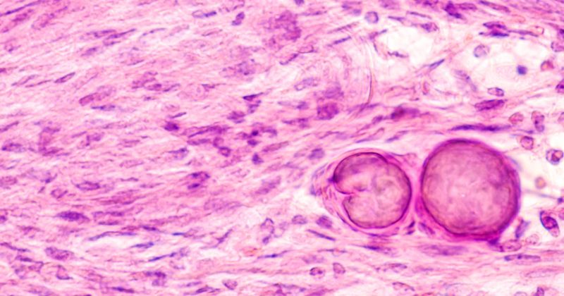 Stereotactic brain biopsy smear cytology of a meningioma, a benign brain tumor of the meninges, showing fascicles of spindle cells with psammoma bodies.