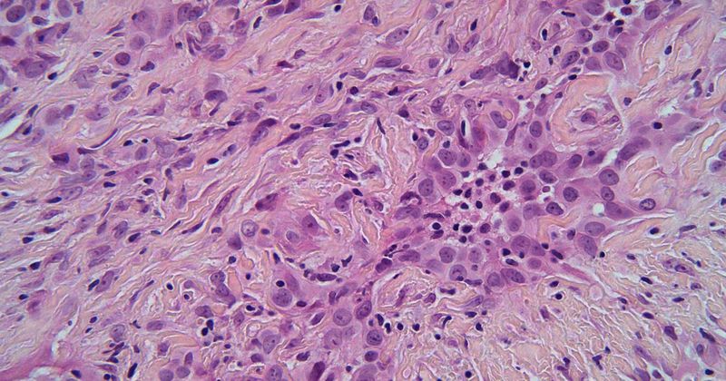 stock image of malignant mesothelioma cells