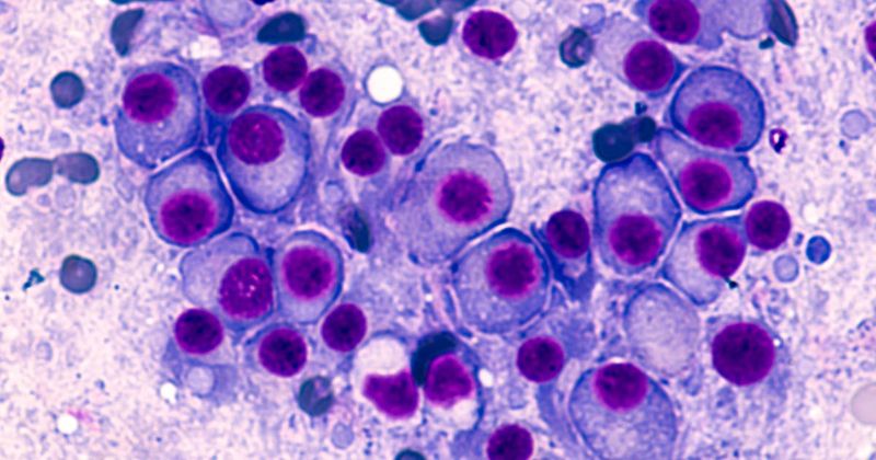 Bone marrow aspirate cytology of multiple myeloma, a type of bone marrow cancer of malignant plasma cells, associated with bone pain, bone fractures and anemia.