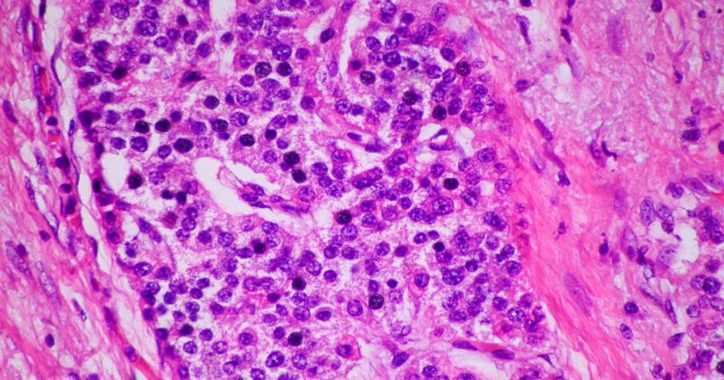 stock image of neuroendocrine tumor