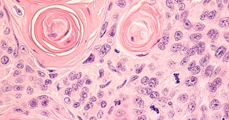 Lung Cancer: Photomicrograph of a CT (CAT) scan-guided needle core biopsy showing pulmonary squamous cell carcinoma, a type of non-small cell carcinoma usually associated with smoking. 