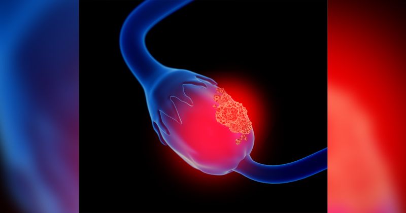 3d illustration of ovarian cancer