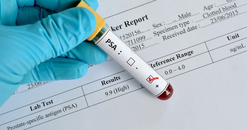 Prostate-specific antigen (PSA) test.