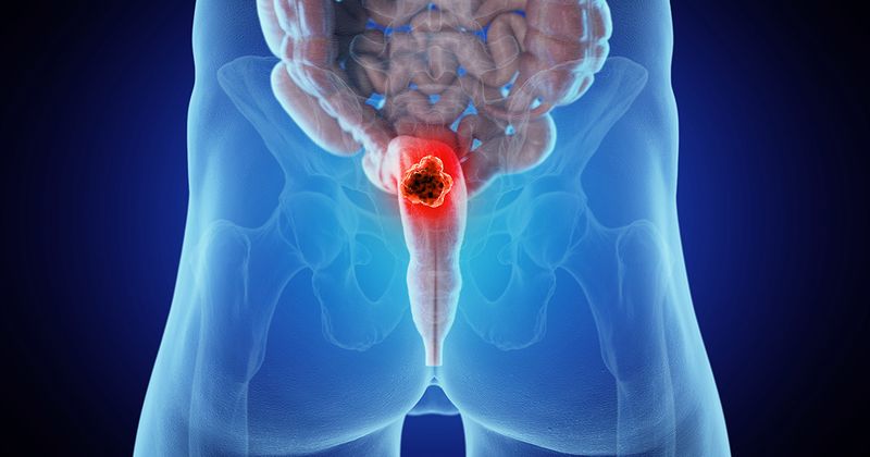 rectal cancer stock image