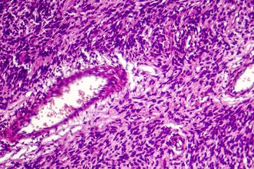 Fibrosarcoma, malignant tumor of fibroblasts, one of soft tissue sarcomas, light micrograph, photo under microscope