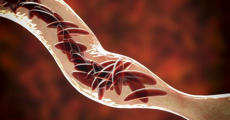  Clumps of sickle cell block the blood vessel. 