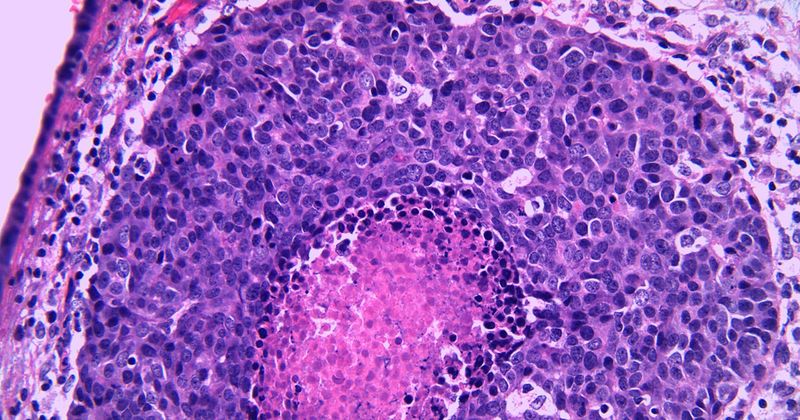 stock image of urothelial carcinoma