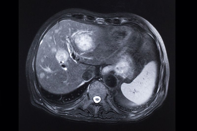 MRI scan of liver