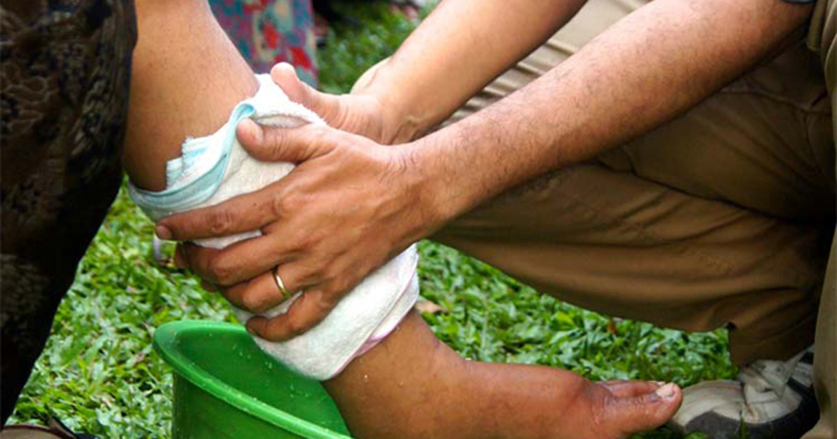 Image: (“Lymphatic filariasis”) 