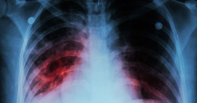 Tuberculosis x-ray