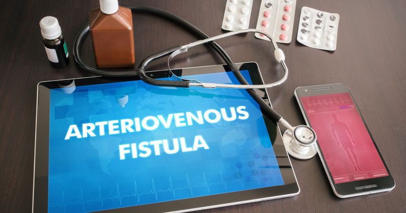 AV fistula