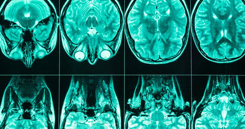 series of brain scan images