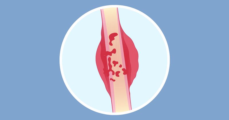 Sarcoma