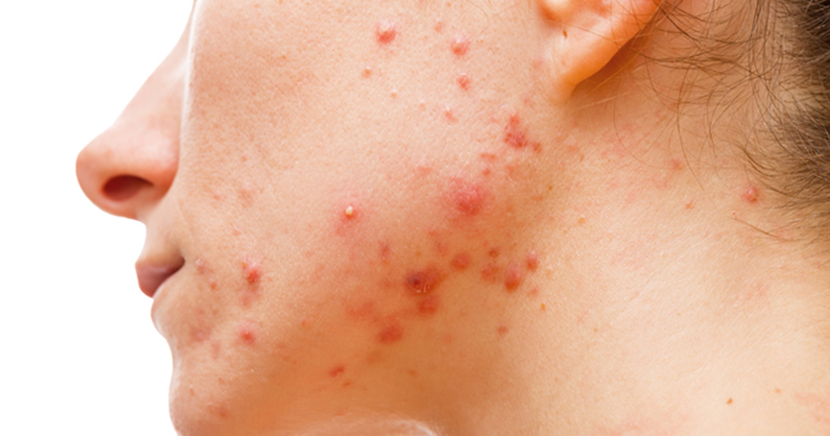 Patient with acne on face