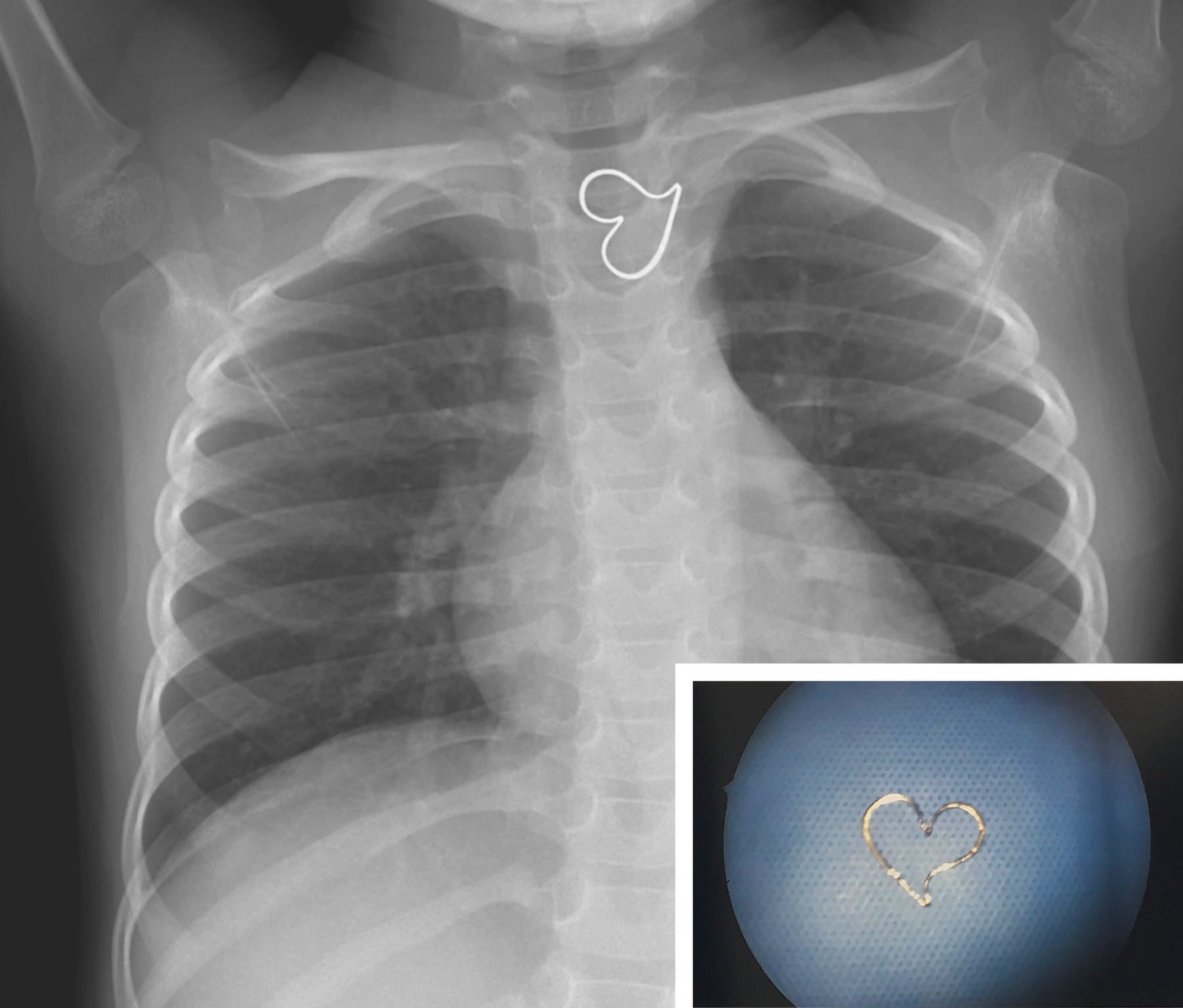 Photo of X-ray with foreign body in esophagus