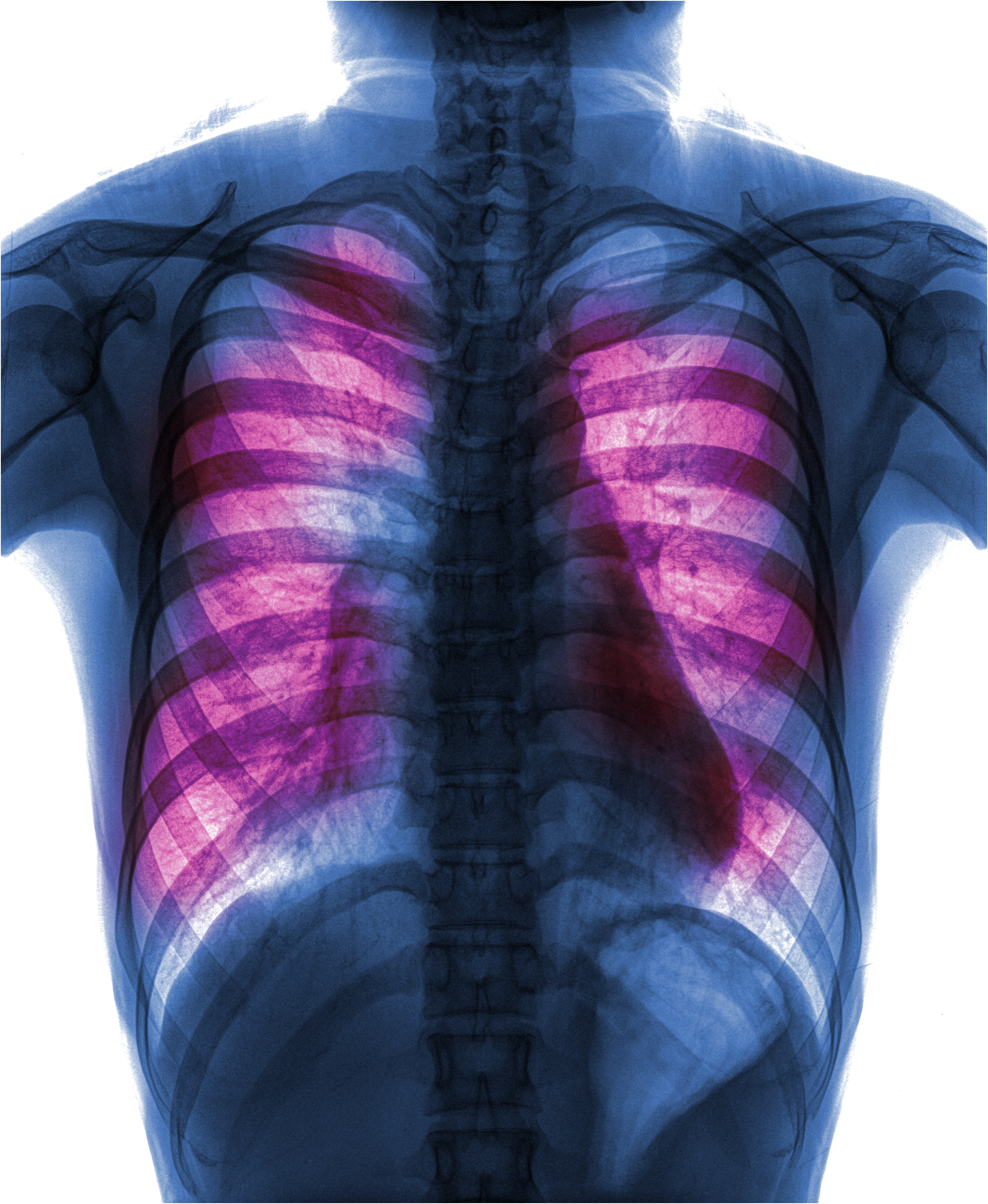 Imaging of infected lungs