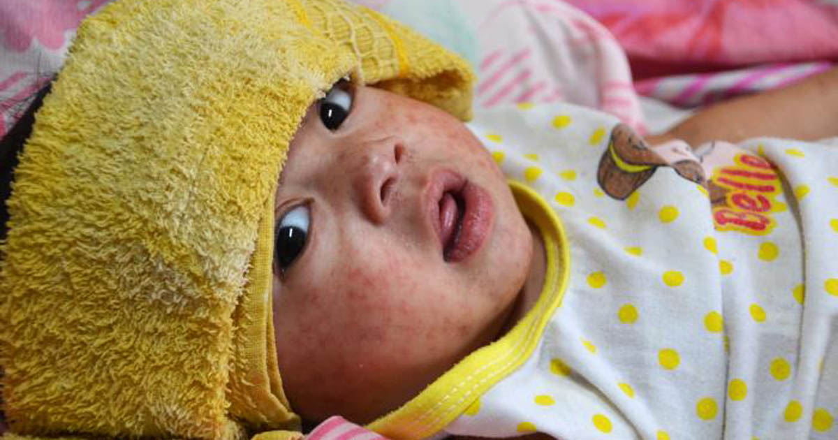 Child with measles