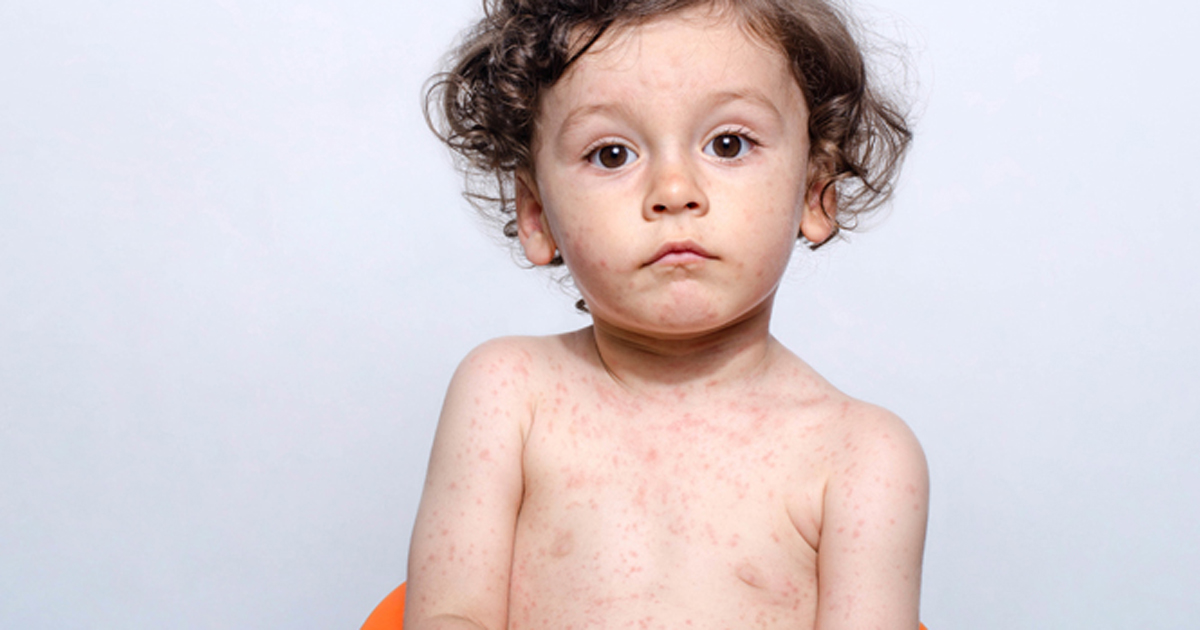 Photo of young boy with measles rash