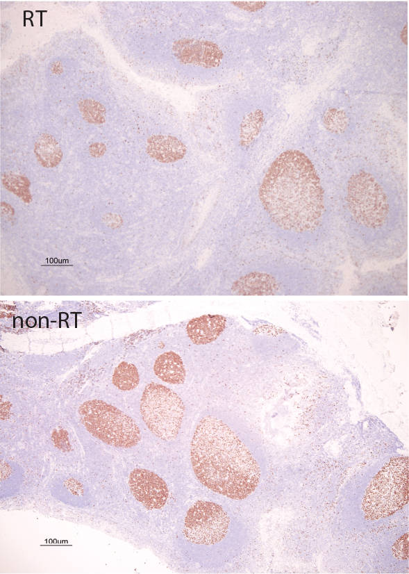 Photo of normal tonsils and tonsils of those with recurrent tonsillitis