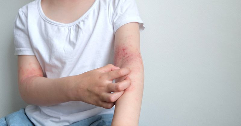 Child scratches atopic dermatitis on arm.