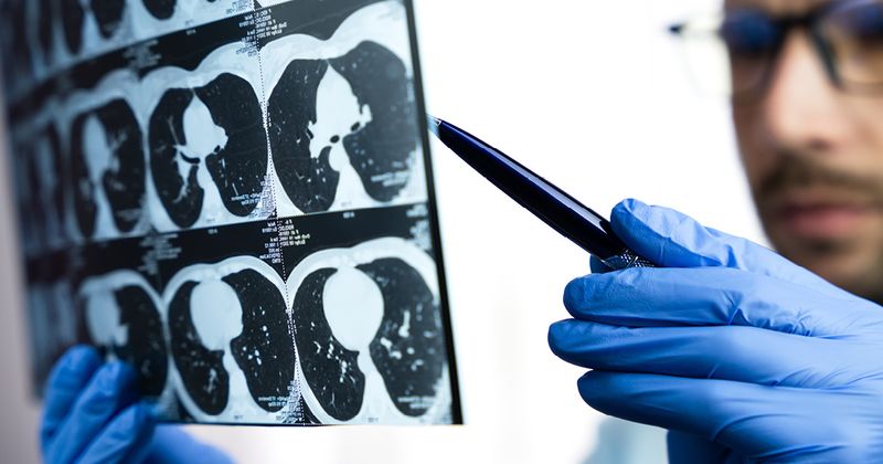 Doctor examining a CT scan of lungs.