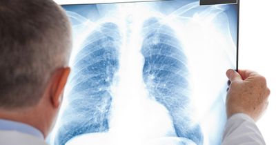 &lsquo;It can save their lives&rsquo;: Annual lung cancer screening improves cancer detection rate