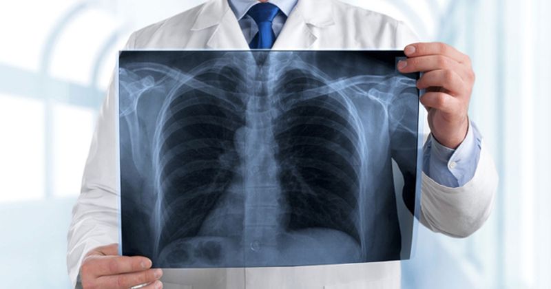 Pneumonia X-Ray