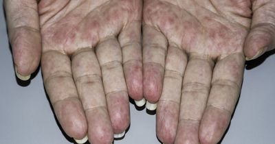 Botulinum toxin reduces pain, disability in Raynaud&rsquo;s syndrome secondary to scleroderma