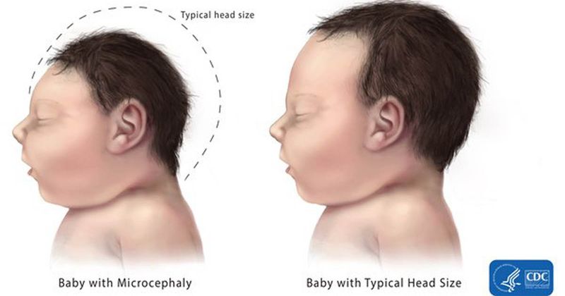 Microcephaly_CDC