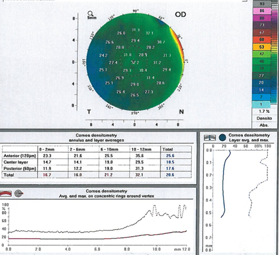 [Fig 1] This normal cornea has a Kmax of 45 D and corneal thickness of 536 µm. Images: Christina Twardowski, OD, FAAO