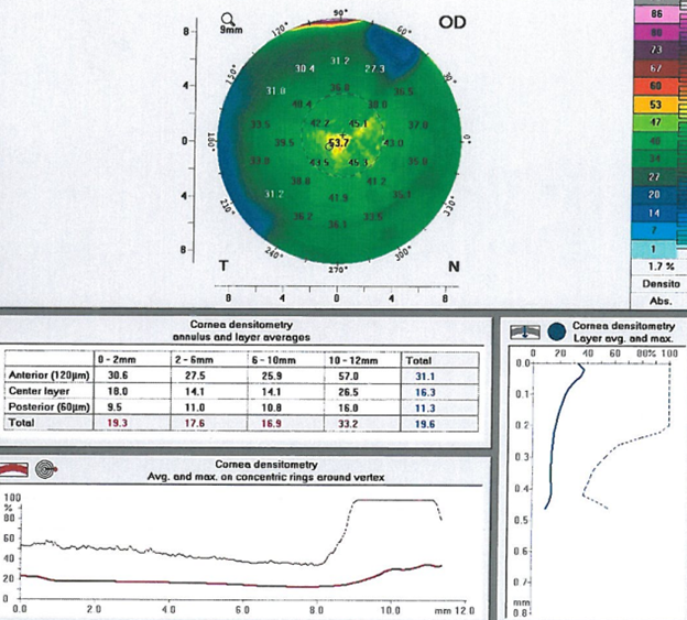 [Fig 2] This pediatric patient with keratoconus has a Kmax of 60.4 D, with a corneal thickness of 460 µm.