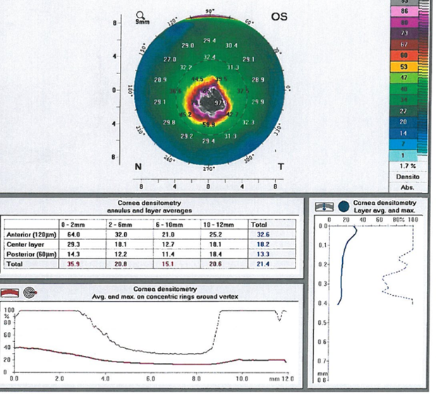 [Fig 3] This pediatric patient with keratoconus has a Kmax of 64.9 D and central corneal thickness of 356 µm. Central scarring from the corneal ectasia process is present.