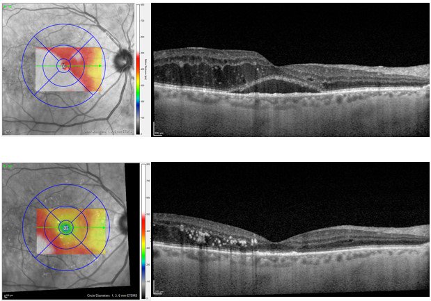 OCT cross-section and retinal thickness profile before (top) and after (bottom) anti-VEGF injections. Image: Jessica Haynes, OD, FAAO