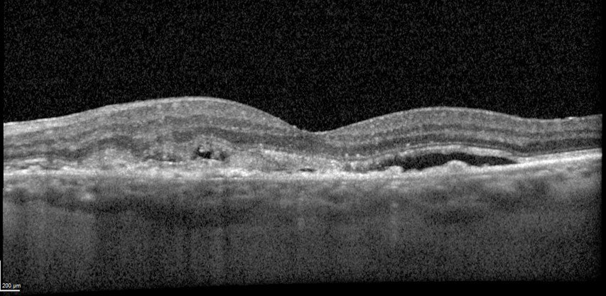 Spectralis (Heidelberg) scan illustrating exudative AMD in the left eye. Image: Jessica Haynes, OD, FAAO