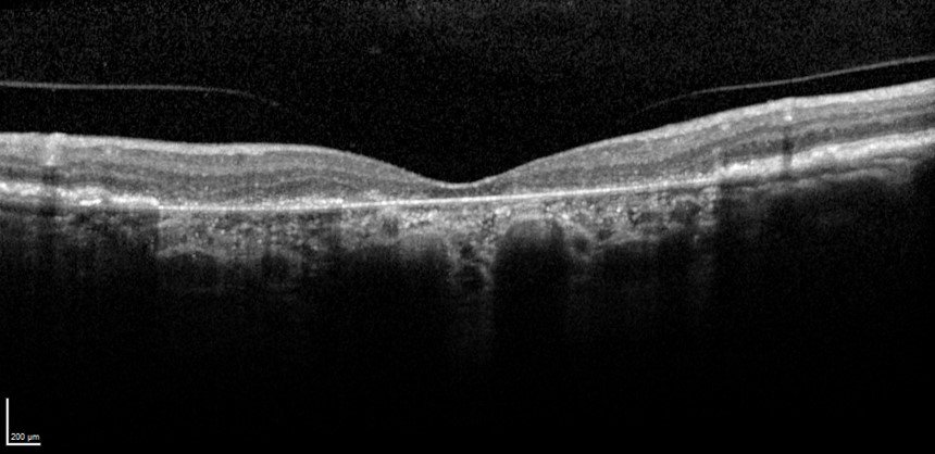 Extensive center involving geographic atrophy from atrophic AMD (yellow bracket). Image: Jessica Haynes, OD, FAAO