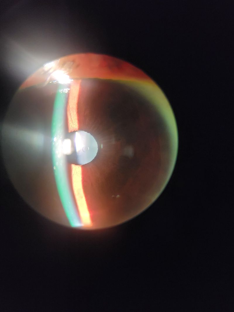 EVO lens in situ with visible central port for aqueous flow. Source: Anu Ondhia, OD